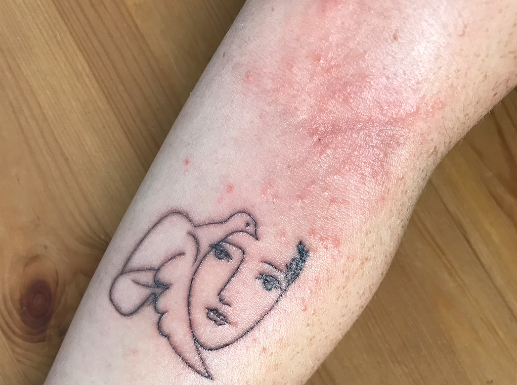 tattoo ink allergy